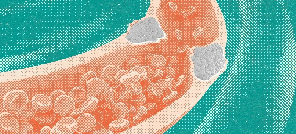 Cholesterol building up in an artery